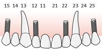En konstruktion med implantat i tandluckan och tandstödda kronor på tänderna vid sidan av tandluckan är ersättningsberättigande. Fyratandslucka 12 22, tillstånd 5035, där regel E.