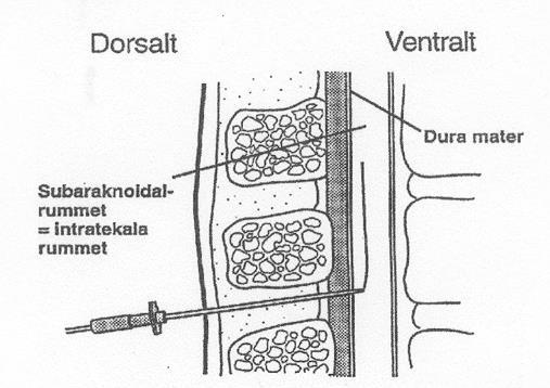 METOD Efter narkosinduktion läggs patienten på sidan och lumbalt sätts en epiduralnål och en epiduralkateter inläggs i spinalkananlen (intratekalt) ungefär 15 cm.