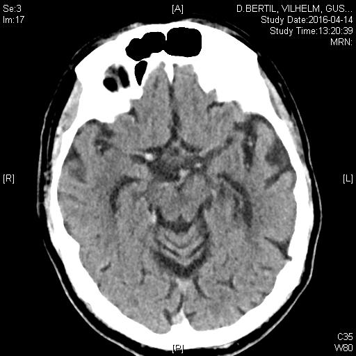 (middle cerebral artery) = mediapropp tpa =