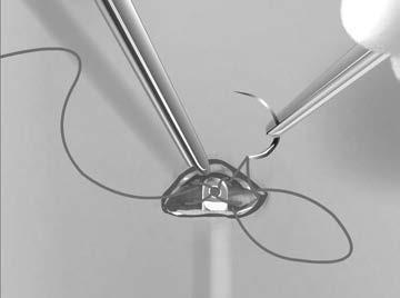 12. Vid det superiora snittet säkrar du förankringshålet i bindvävshinnan med hjälp av de redan utplacerade suturerna från steg 6 (Figur 5 Förankra den subkutana elektrodens distala spets på sida 13).