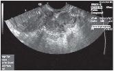 Diagnostisk värdi af humant choriongonadotropin-ratio versus enkelte s-humant choriongonadotropin målninger ved graviditet med ukendt lokalisation. Ugeskrift for Läger 21/2014 4. (http://mags.