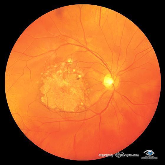 RISK FOR LOW VISUAL ACUITY AFTER 1 AND 2 YEARS OF TREATMENT WITH RANIBIZUMAB OR BEVACIZUMAB FOR PATIENTS WITH NEOVASCULAR AGE-RELATED MACULARDEGENERATION Susanne Albrecht, RC Syd Karlskrona ÖGONDAGAR