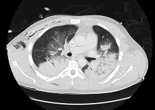 Multitrauma,CT bilat lungkontus.
