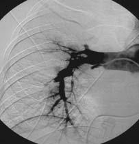 Interventioner i thorax Pulmonalisangiografi Biopsier (lungor, mediastinum)