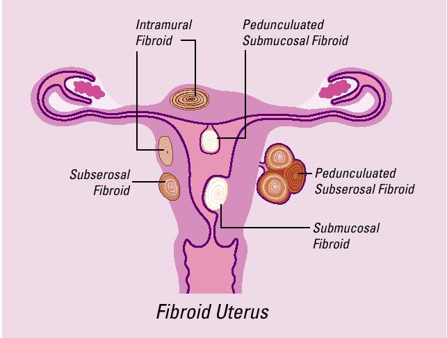 myom MR Blodförs rsörjningrjning Uterine Fibroid