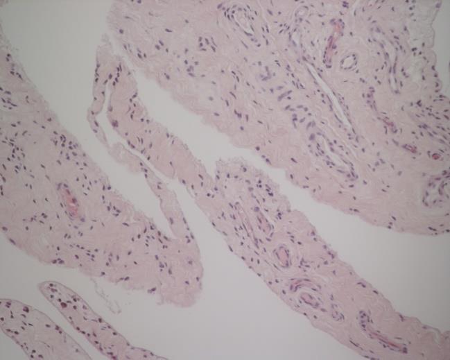 Figur 5a: : Representativ immunofluorescensinfärgning av ledkapsel från OA led. Gul infärgning (NGF), Blå kärninfärgning (DAPI) 20x förstoring Figur 5b: HE färgad ledkapsel från samma OA led som fig.