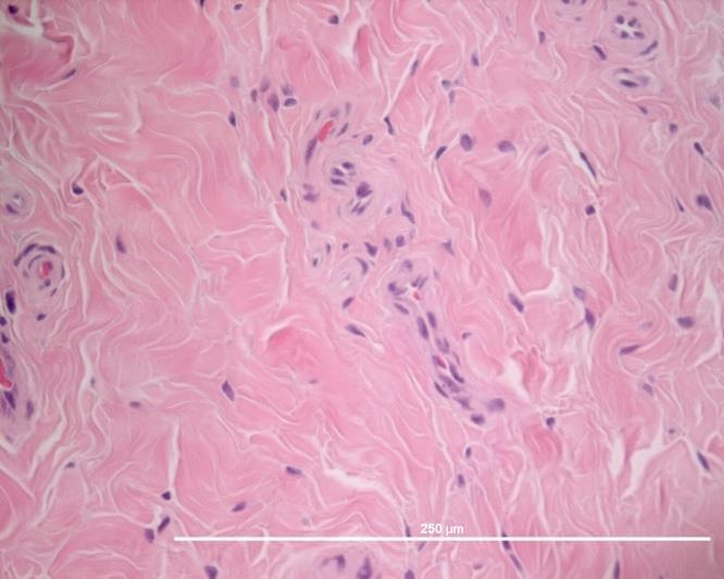 I ledkapsel från OA leder var immunofluorescensen avseende IL-1β också sparsam och det fanns ingen skillnad i förekomst mellan normala och OA-leder.