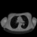 CT, horizontal slice CT, frontal slice 0 100 200 300 0 100 200 300 Figure 2:
