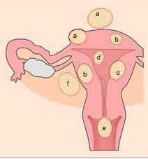 Uterusmyom symptom Mycket rikliga menstruationer (normal ~30 60ml; riklig >80 ml) Dessa kvinnor kan blöda flera 100 ml per mens, som ofta varar 6 8 dagar