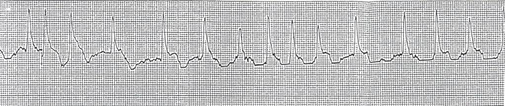 Fråga 44 Tolka rytmen på följande EKG (1