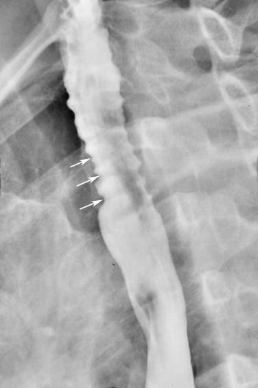 Kan eosinofil esofagit ses på röntgen?