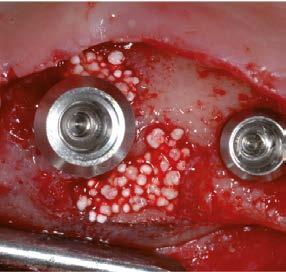 alveolarutskottet dag 0 dag 4