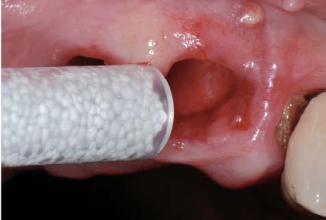 Applicera GUIDOR easy-graft