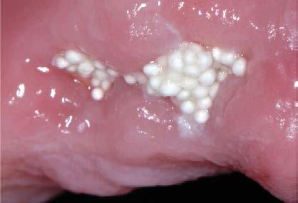 ben/ förhindra resorption