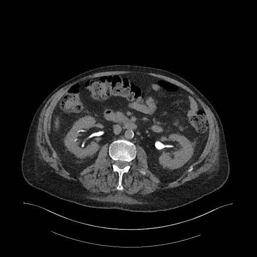 Fig 2: IVU bild efter 12 Fig 3: Lågdos CTU axialbild Fig 4: Lågdos CTU efter minuter (Källa: Ryhov) (Källa: Ryhov) 12 minuter (Källa: Ryhov) Konventionell urografi Metodbladet för IVU som används på