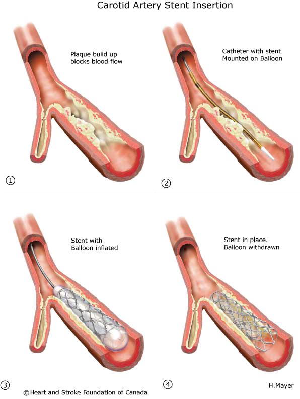 Instabil angina Symptom/karakteristika: Nydebuterad angina pectoris av kraftig art