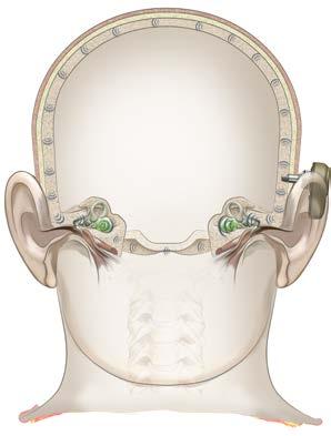 Ledningshinder eller kombinerad hörselnedsättning Användare med ledningshinder, där hörseln fortfarande kan förbättras genom ljudförstärkning, kan vara lämpliga kandidater för en benförankrad