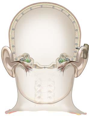 Ensidig dövhet (SSD) grav unilateral sensorineural hörselnedsättning Användare som är döva på ena örat och kan höra normalt med det andra kan vara lämpliga kandidater för en benförankrad hörapparat.