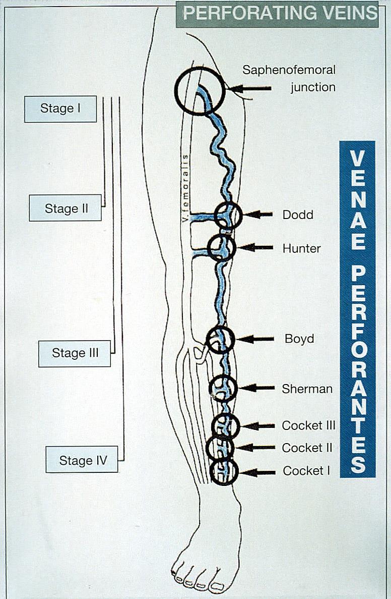 Djupa Perforanter vener Ytliga på - femoral lår vener