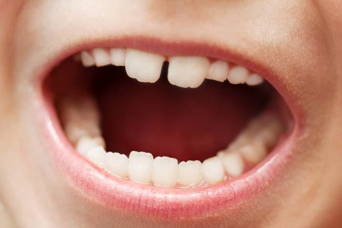 TANDHÄLSORAPPORT Uppföljning av tandhälsan hos barn och ungdomar i