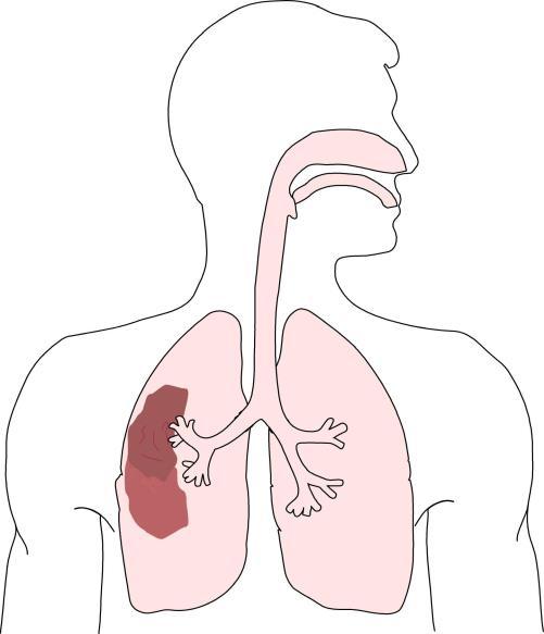 Antibiotikabehandling av pneumoni i slutenvård Lindrigt sjuk patient Svårt sjuk