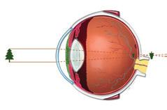 SÅ FUNGERAR SYNEN VANLIGA SYNPROBLEM Våra ögon kan jämföras med en kamera. När vi tittar på något reflekteras ljuset från objektet och in i ögat genom hornhinnan.