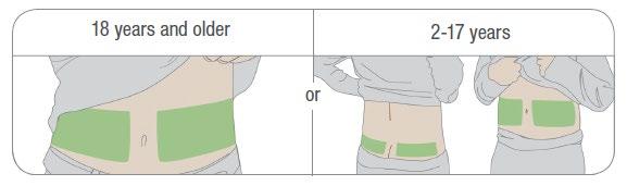 Ignorera inte brutna eller lossnade sensortrådar. En sensortråd kan vara kvar under din hud. Om detta händer, vänligen kontakta din lokala Dexcom-representant.