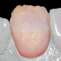 Framställa en naturlig incisal tredjedel: Använd Mamelon material för att skapa en naturlig färgeffekt i den