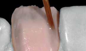 restaurationen kan IPS Ivocolor Essence