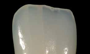 imitera incisal missfärgning, svämmas E