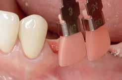 Färgen på gingivan bestäms genom Gingiva Solution shade guide innan lokal anestesi läggs eller tanden prepareras.