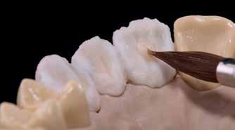 Täck ponticområdena ordentligt med Power Dentin och se till att områdena understöds ordentligt.