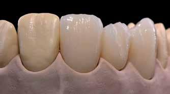 Genomför 1:a Dentin/Incisalbränning på honey-comb brännbrickan, som tillhör brännugnen med de angivna brännparametrarna (brännparametrar finns på sidan 61).