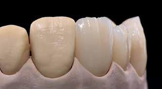 2:a Dentin och Incisal bränning Kontrollera hela restaurationen och rengör den grundligt.