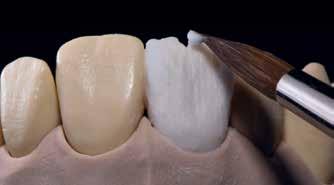 Skikta dentinkärnan med Dentin skiktningsmaterial antingen direkt med en antydande mamelonform eller bygg upp den anatomiska formen helt och reducera i nästa steg (cut-back