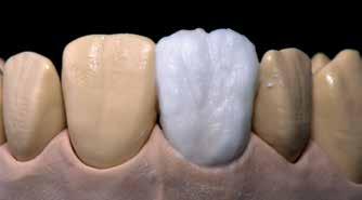 För individuell karaktärisering av den incisala tredjedelen använd Impulse material (t.ex. Opal Effect och Mamelon).