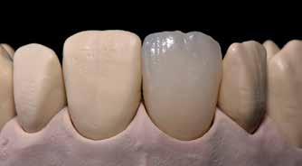 Genomför 1:a Dentin/Incisalbränning på honey-comb brännbrickan, som tillhör brännugnen med de angivna brännparametrarna (brännparametrar finns