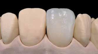 Torka restaurationen och komplettera med Dentin, Transpa och Incisal material där det behövs.