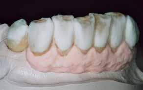 1 2 3 Applicera gingiva-materialen enligt