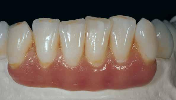 Stain och Glaze-bränning De gingivala delarna karaktäriseras och glaseras tillsammans med de tandfärgade delarna av restaurationen.