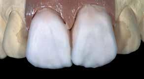Brännparametrar för Veneer Dentin/ Impulse-bränning finns på sidan 62.