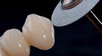 Add-On Dentin/Incisal/Bleach Blanda Add-On Dentin och Insical i förhållande 1:1 med Dentin och Transparent Incisal material.
