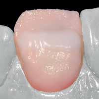 wash-skiktet eller ZirLiner, kan djuphetsvärdet i dentinområdet ökas. Samma områden täcks sedan med Dentin material.