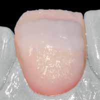ljushetsvärdet i den incisala tredjedelen, t.ex. vid begränsat utrymme, kan Inter Incisal white-blue användas.