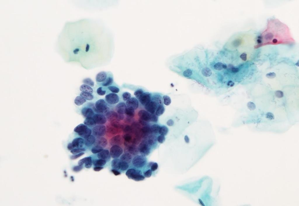Cervixcancerprevention