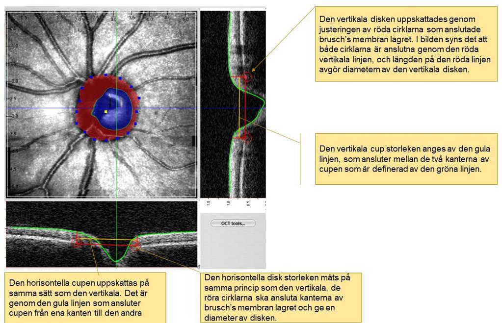 3.2.2 Analys av synnervens topografi När bilderna var tagna med OCT kameran visades synnerven i genomskärning. I Figur 3.