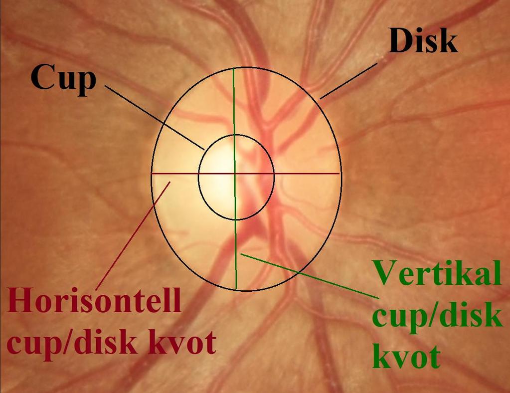 Figur 4.4: De olika cup/disk förhållanden som bedömdes av optikerna, där cup/disk area kvoten är förhållandet mellan lilla cirkelns area med den stora cirkelns area.