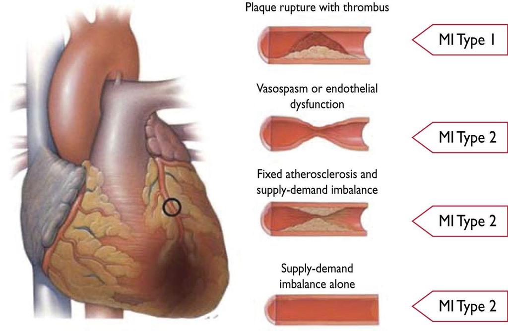 Differentiation between myocardial infarction
