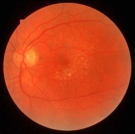 Torr, atrofisk AMD (Ca 85% av AMD)