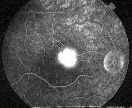 Våt AMD, fluoresceinangiografi.